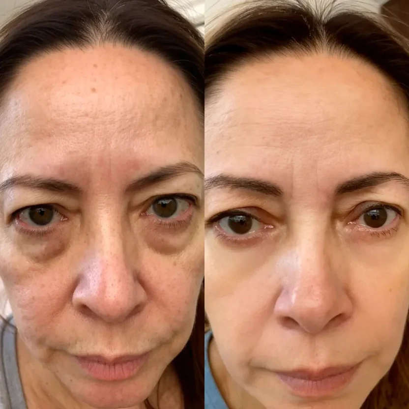 Rezultat Nine Novak po uporabi EyeLux Pro