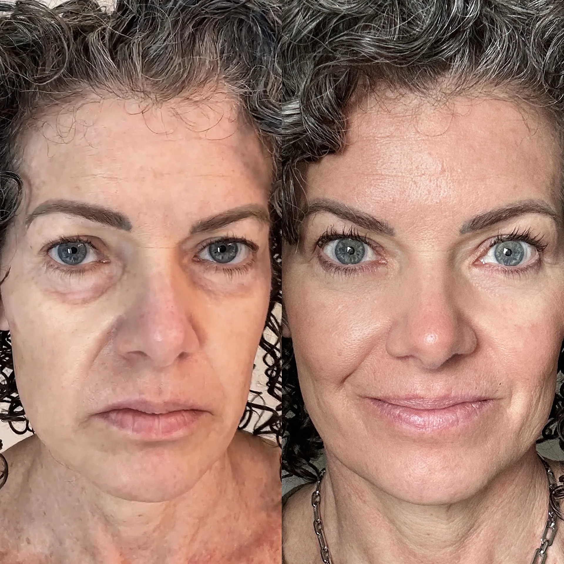 Rezultat Katarine Petrovčič po uporabi EyeLux Pro