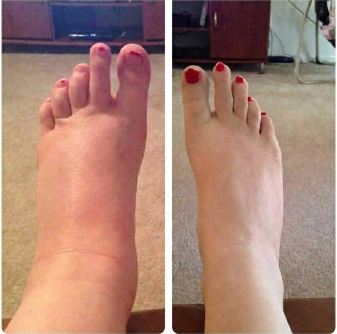 Resultado Conceicao R. - Pernas desinchadas