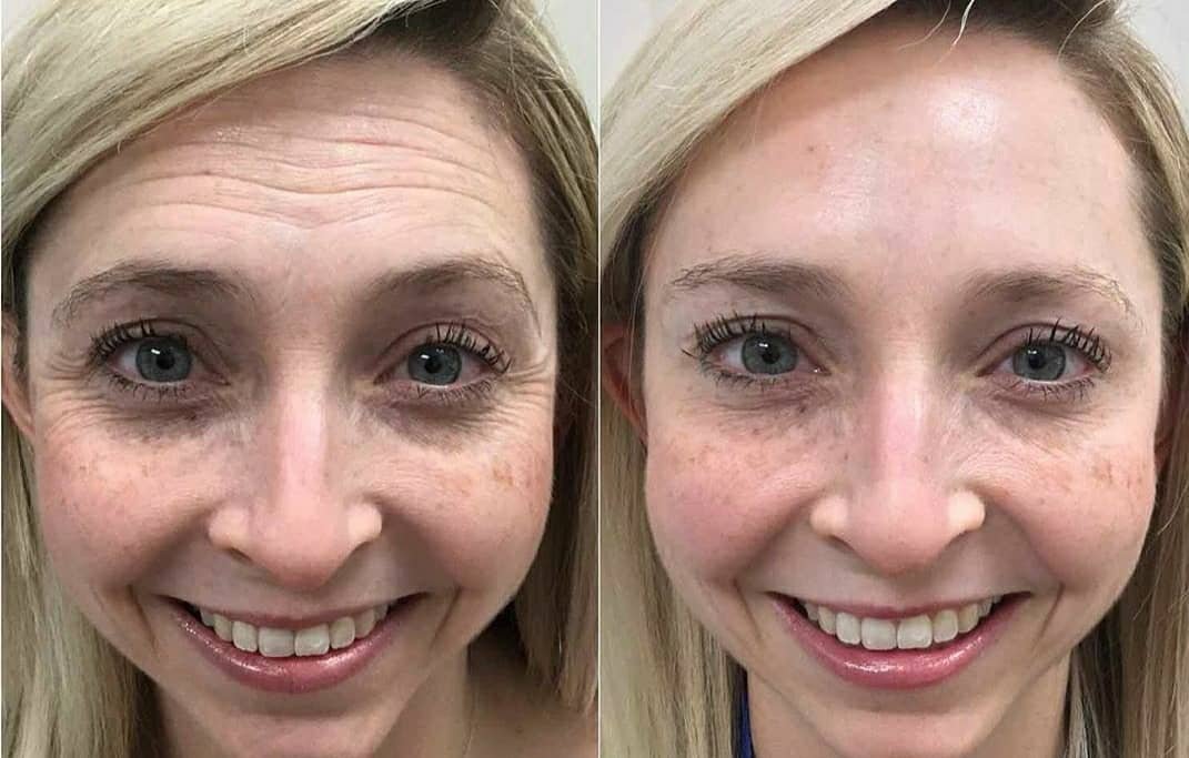 Resultado Amélia R. - Redução de linhas de expressão