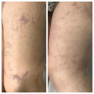 Resultado de Maria Santos após usar MiracleSocks