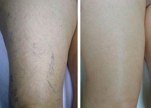 Resultado de Carlos Oliveira após usar MiracleSocks