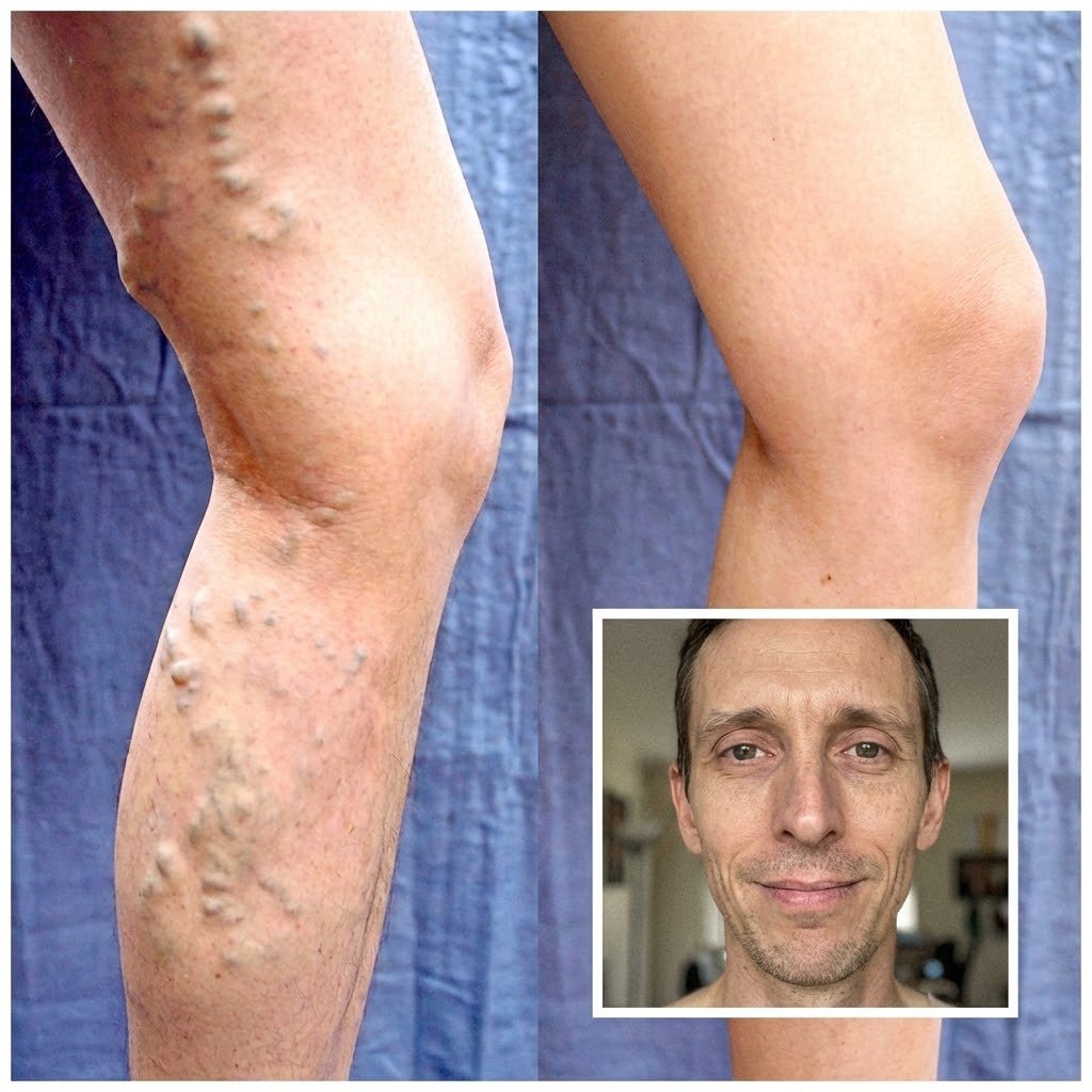 Resultado Manuel P. - Pernas mais leves