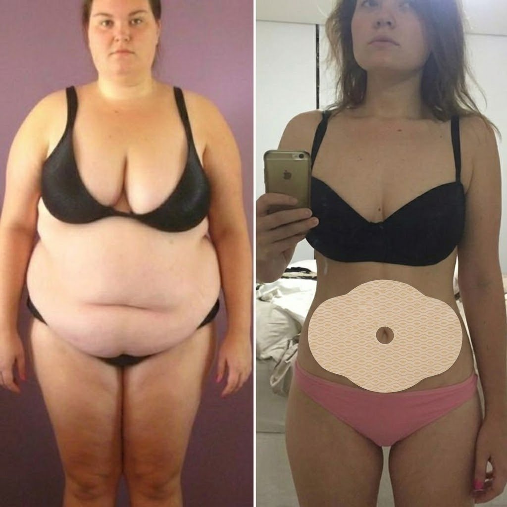 Resultado Fernanda R. - Redução visível da barriga