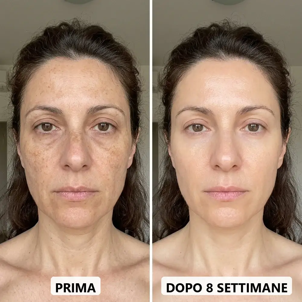 Prima e dopo: macchie più chiare e tono uniforme